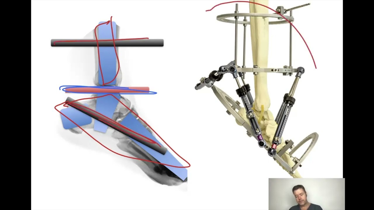 Foot Frame  Strategy and Osteotomies