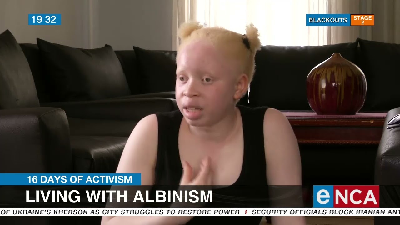 16 Days of Activism | Living with albinism