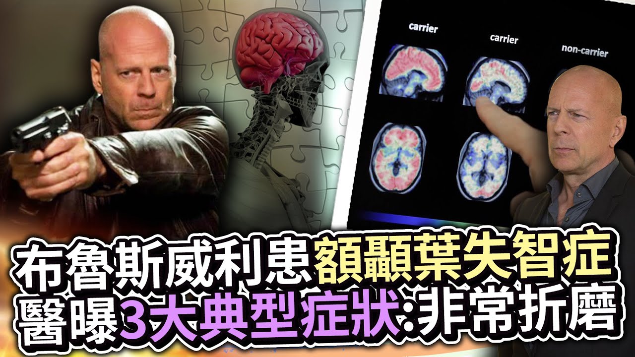 布魯斯威利患「額顳葉失智症」　醫曝3大典型症狀：非常折磨 @ChinaTimes