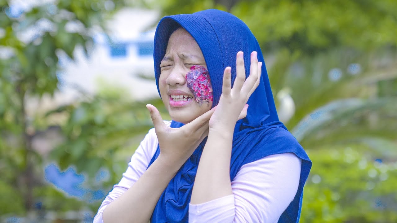 WAJAH DINDA TERBAKAR