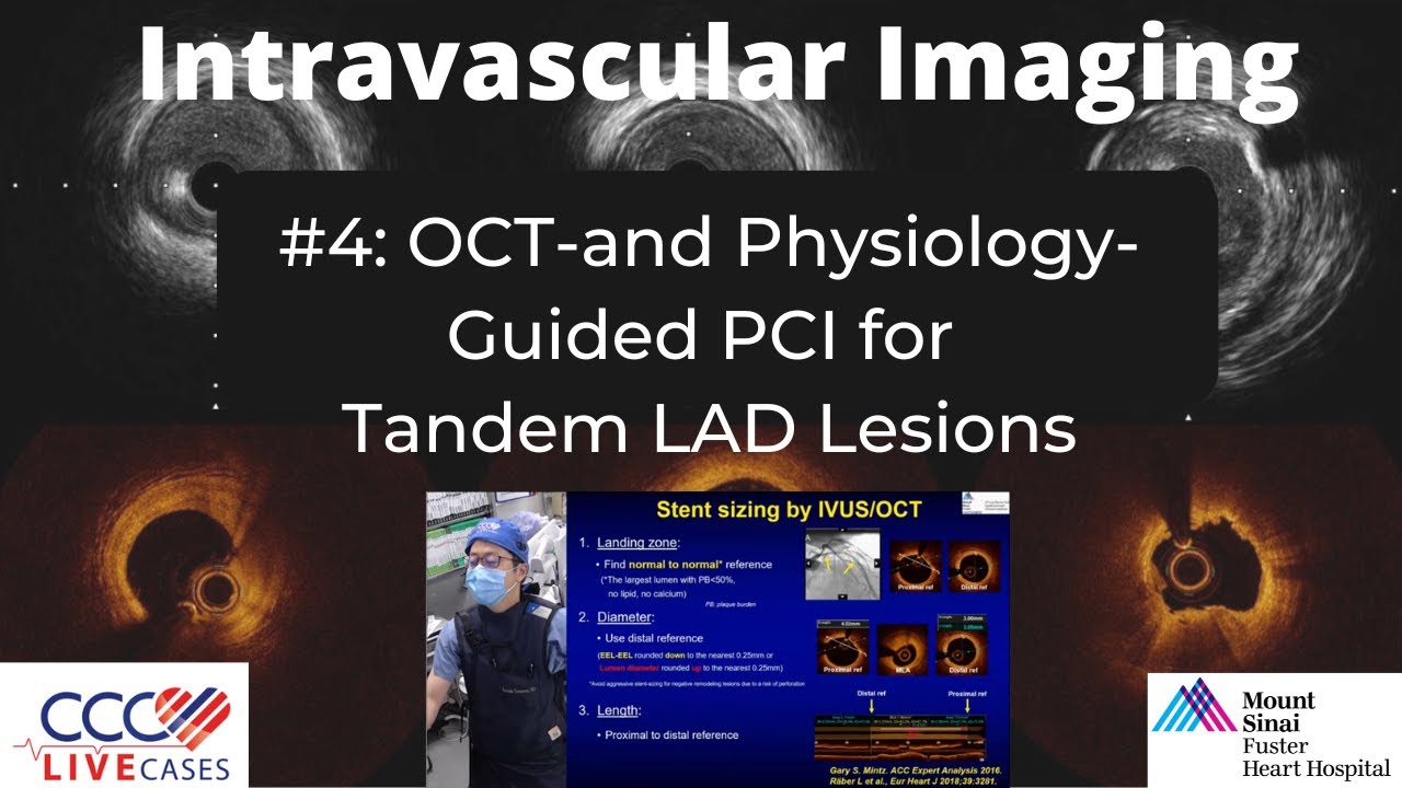 OCT-and Physiology-Guided PCI for Tandem LAD Lesions