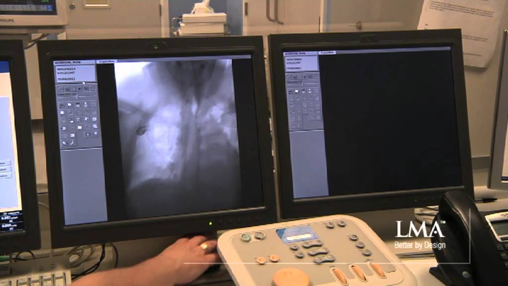 Case Report: Stenting of a Stenosed Vertebral Artery