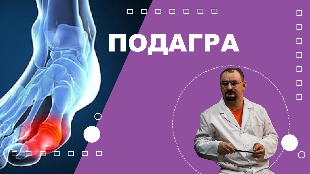 Подагра. Лечение подагры.
