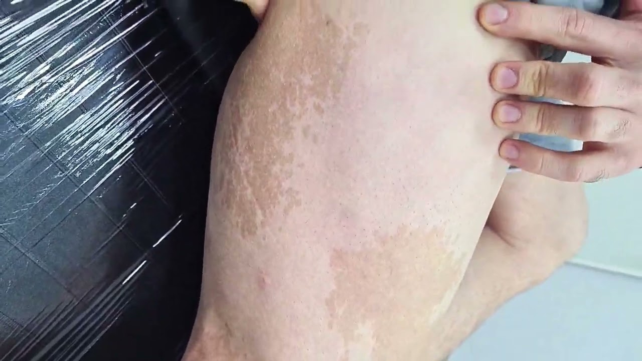 Voc&ecirc; sabe o que &eacute; mancha Caf&eacute; com Leite na pele? Nevo de Becker Remo&ccedil;&atilde;o de manchas de pele a laser