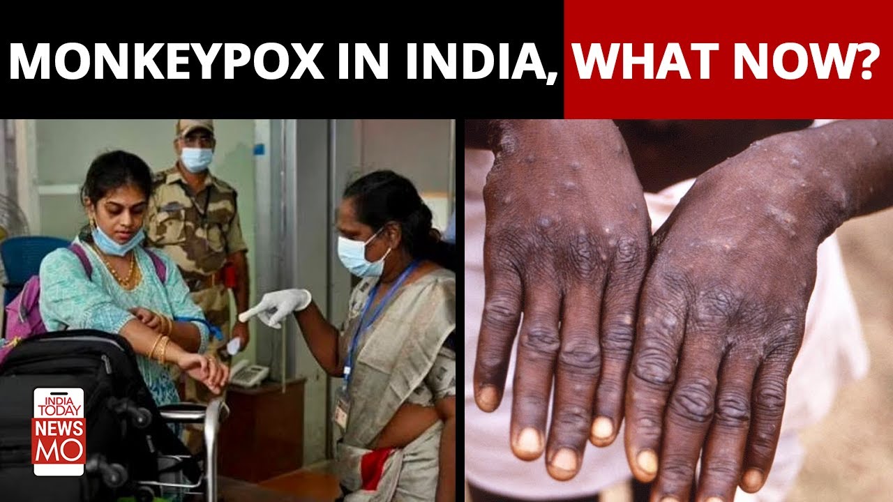 Monkeypox In India, What Now?