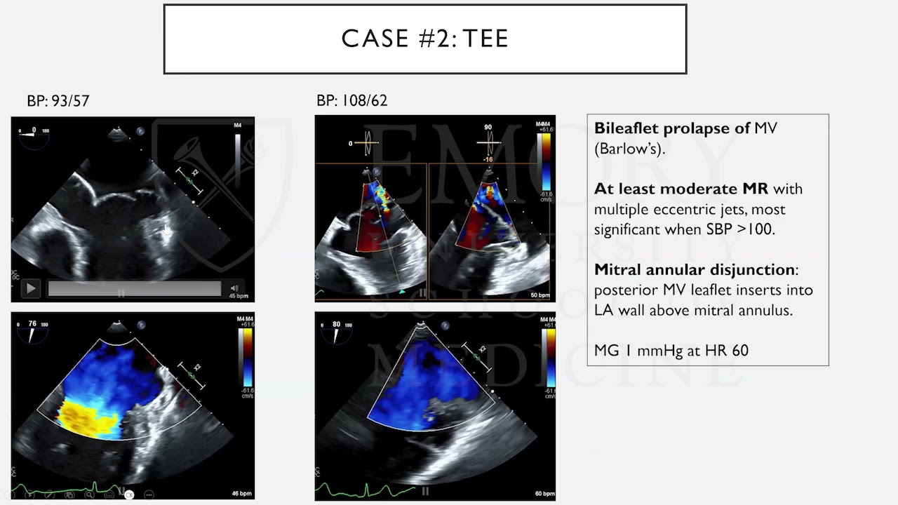 Mitral Valve Prolapse