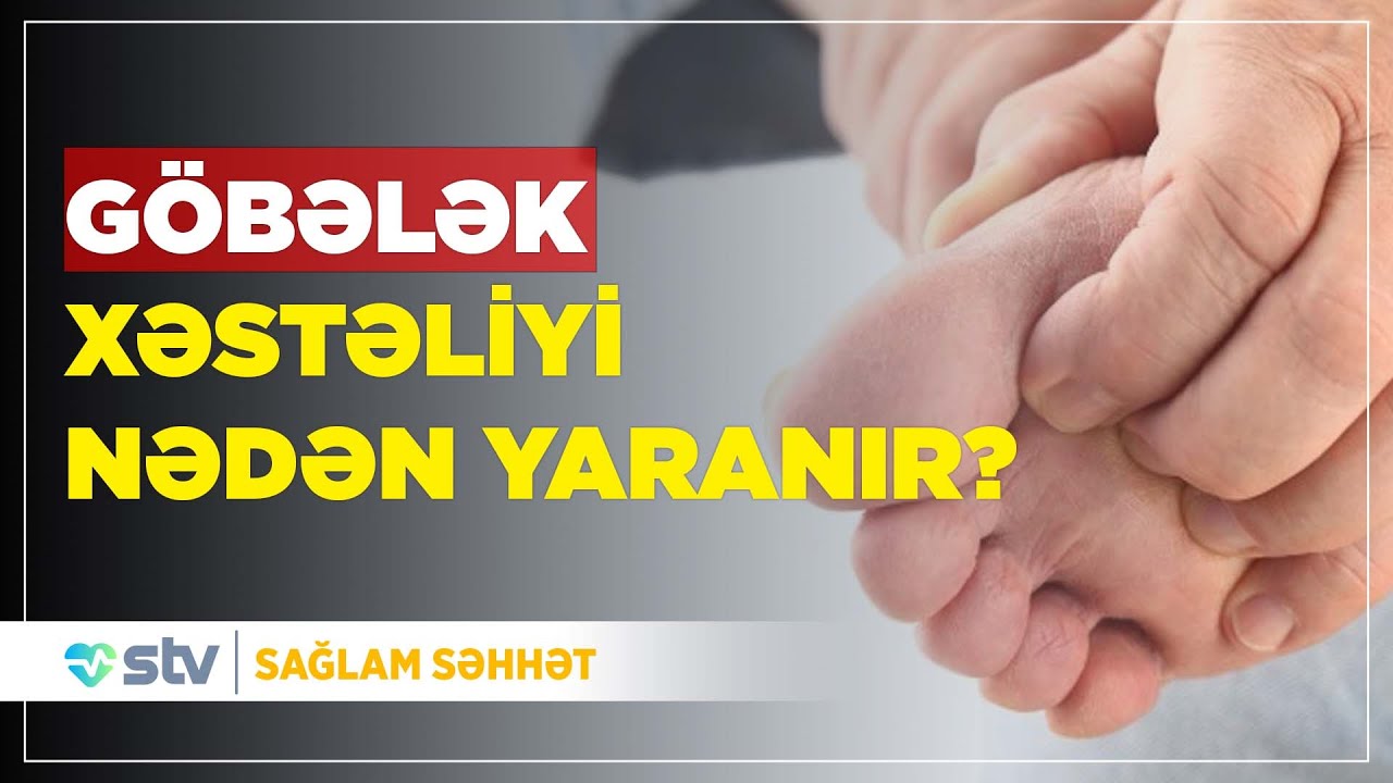 Ayaq göbələyinin müalicəsi necə aparılır?