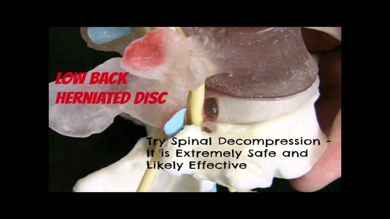 Untreated Sciatica Leads to More Severe Problems- South Austin Chiropractor