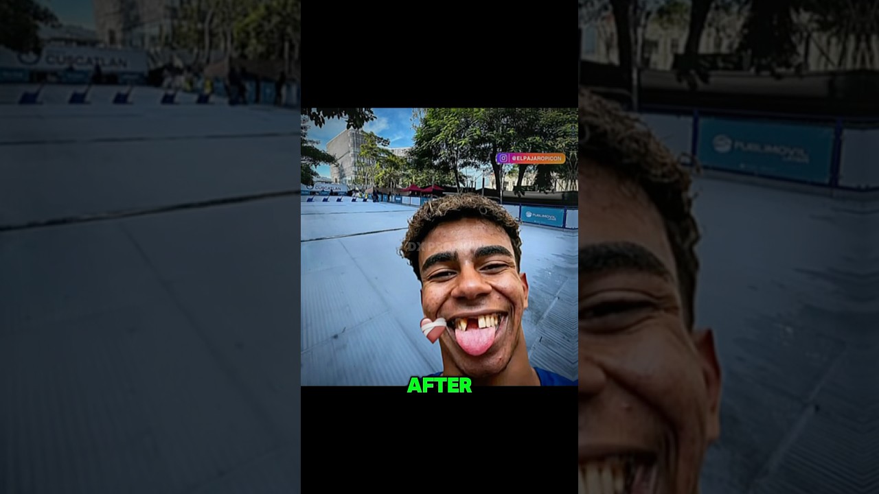 Lamina Yamal teeth Surgery Fail💔🩹❤️&zwj;🩹#football #shortvideo #viralvideo #shorts #footballshorts