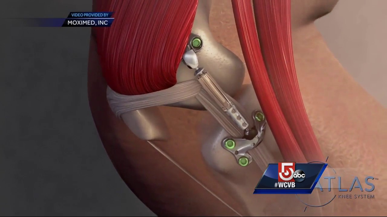 Could patients avoid knee replacement surgery with new implant?