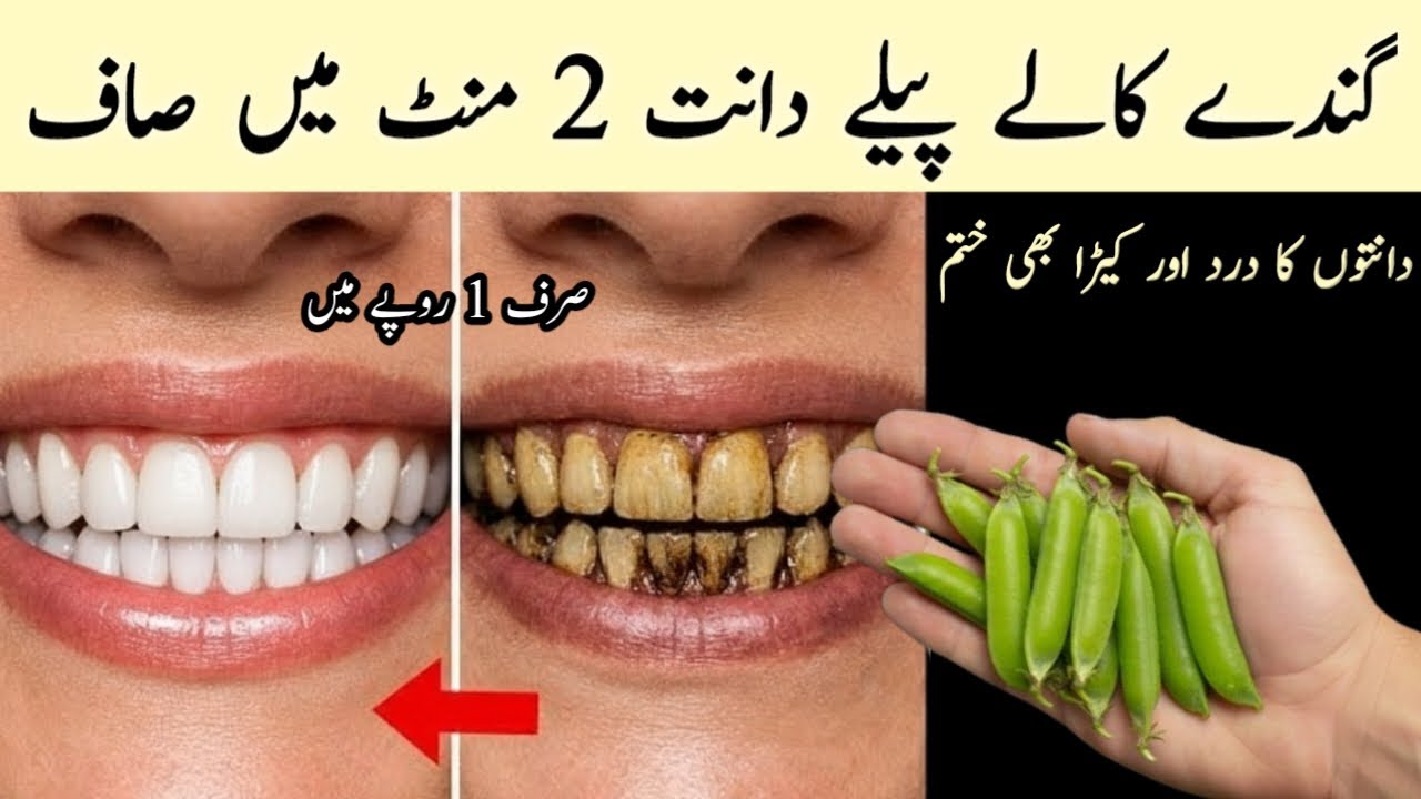 just in 1 rupee will make dirty, rotten, yellow teeth shine like pearls 😱Teeth whitening remedy