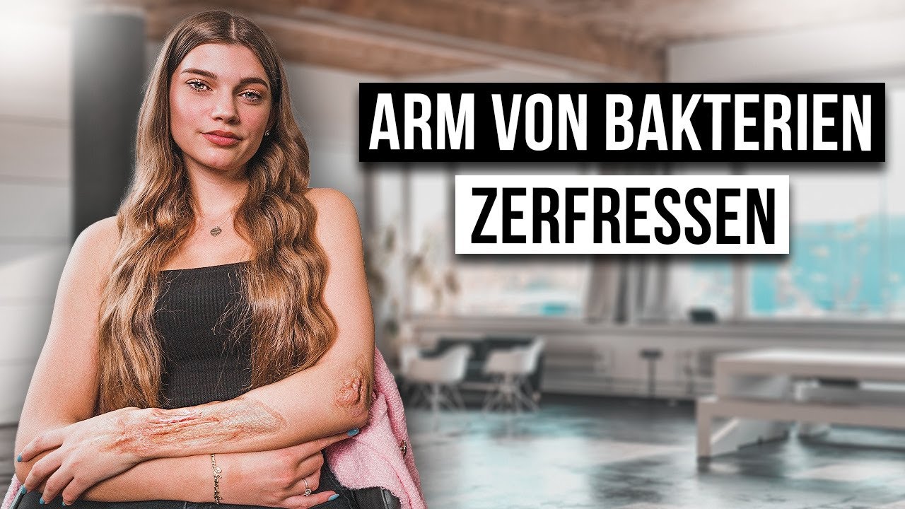Wie ist das MORBUS CROHN ZU HABEN?