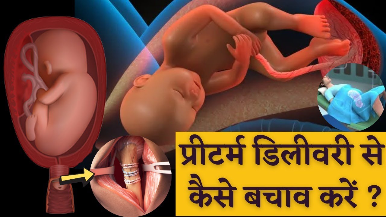 प्रीटर्म डिलीवरी से कैसे बचाव करें ?𝗧𝗜𝗣𝗦 𝗧𝗢 𝗣𝗥𝗘𝗩𝗘𝗡𝗧 𝗣𝗥𝗘-𝗧𝗘𝗥𝗠 𝗗𝗘𝗟𝗜𝗩𝗘𝗥𝗬, बहुत 𝗜𝗠𝗣𝗢𝗥𝗧𝗔𝗡𝗧 है सभी के लिए