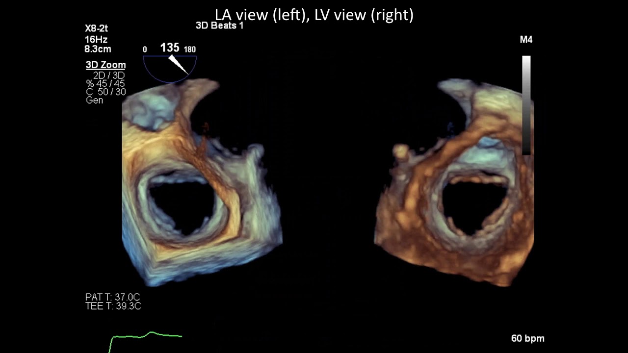 3D TEE of a Normal Mitral Valve