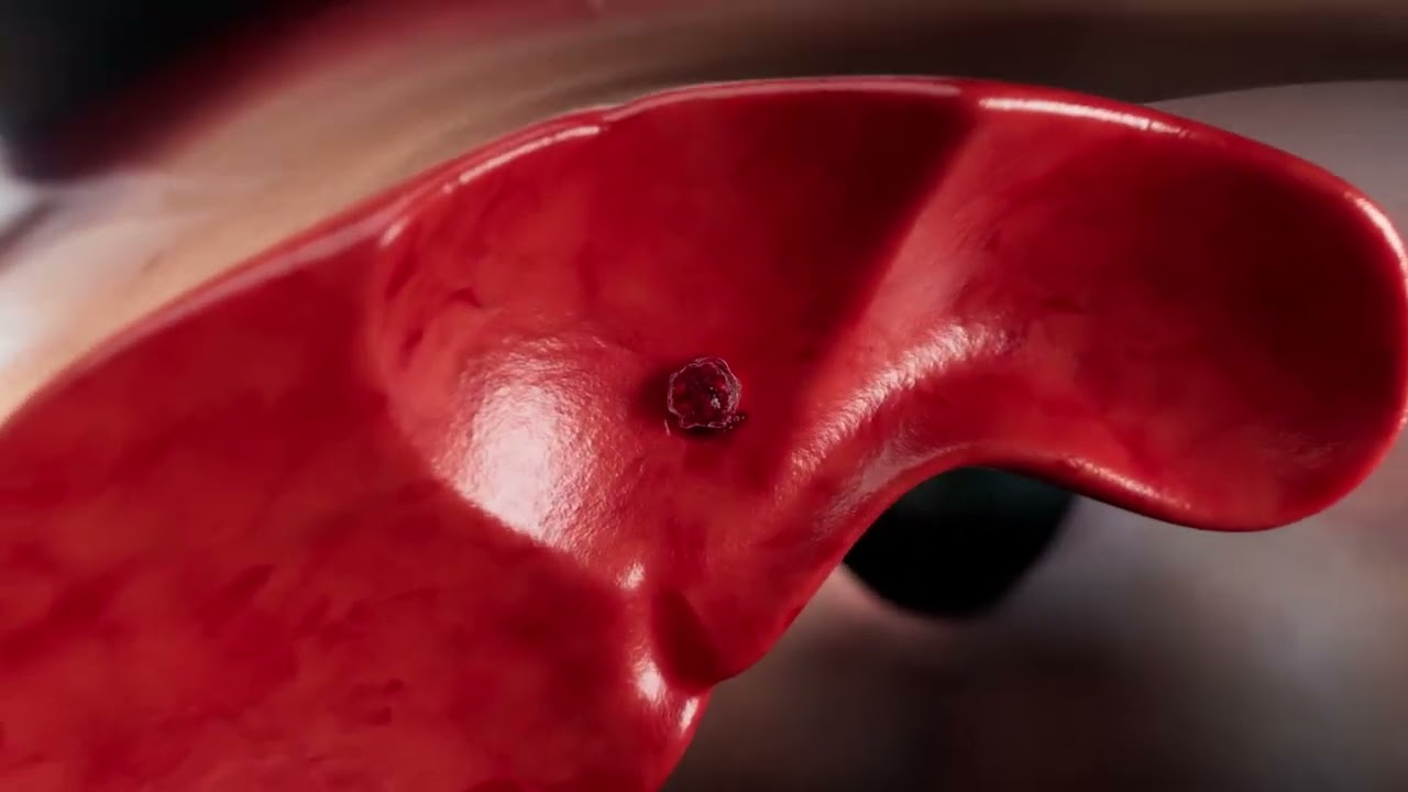 HistoSonics&rsquo; Histotripsy System Demonstrates 90% Local Tumor Control at 12 Months in #HOPE4LIVER...