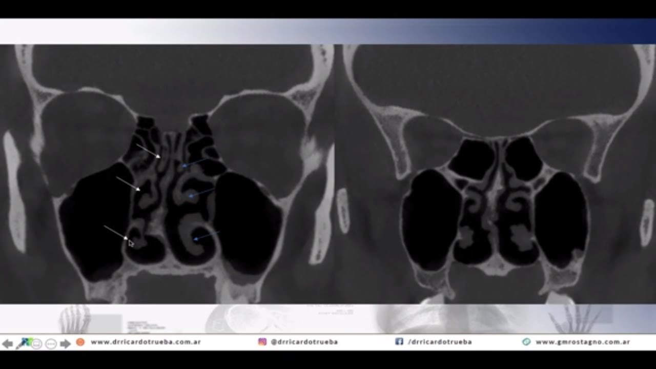 TOMOGRAFIA DE LOS SENOS PARANASALES