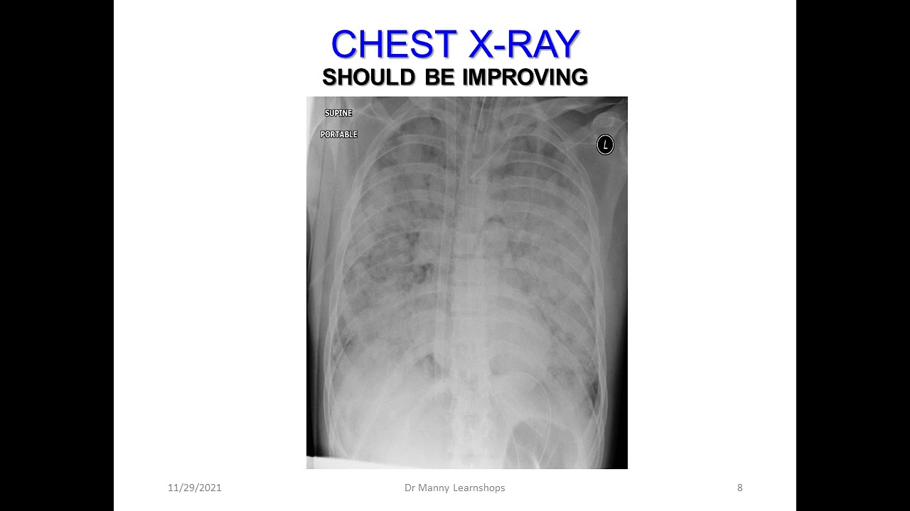 Dr Manny VV ECMO Learn shop part 7: Weaning from V-V ECMO