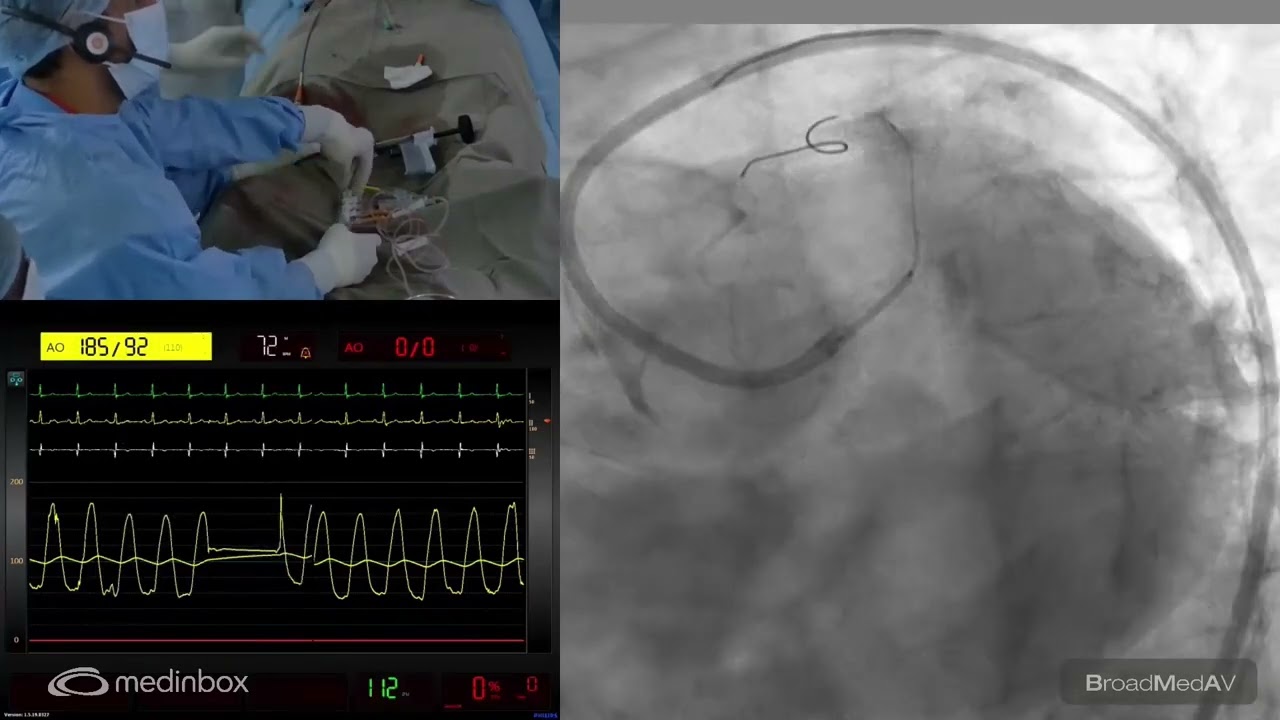 IVUS-Guided PCI to Ostial LM Using IVL