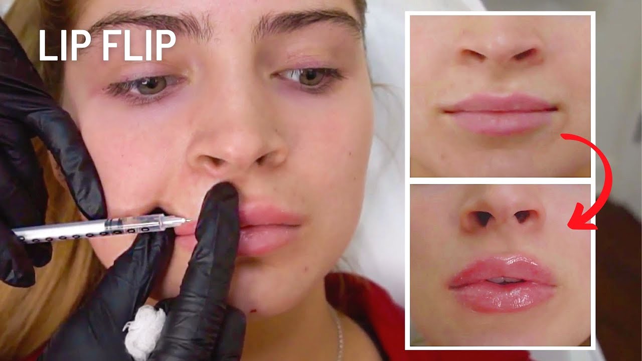 Before & After Natural Botox Lip Flip (ft. Carrington Durham)