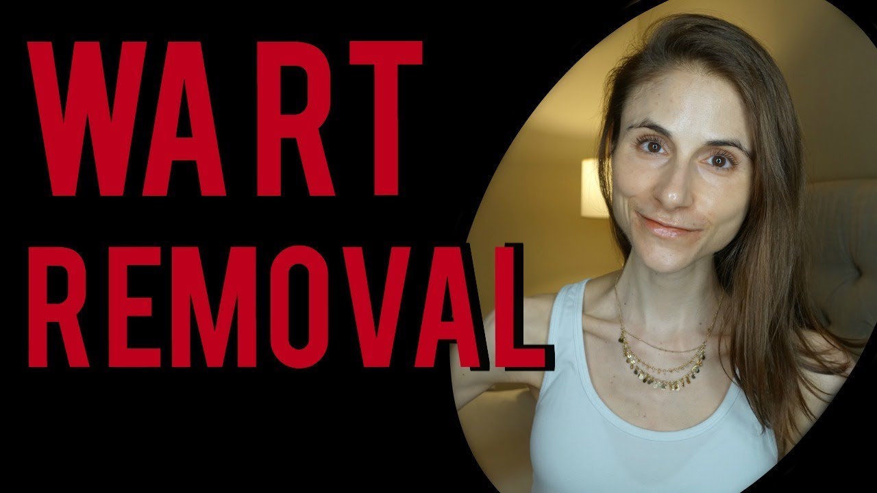 WART REMOVAL: Q&A WITH DERMATOLOGIST DR DRAY