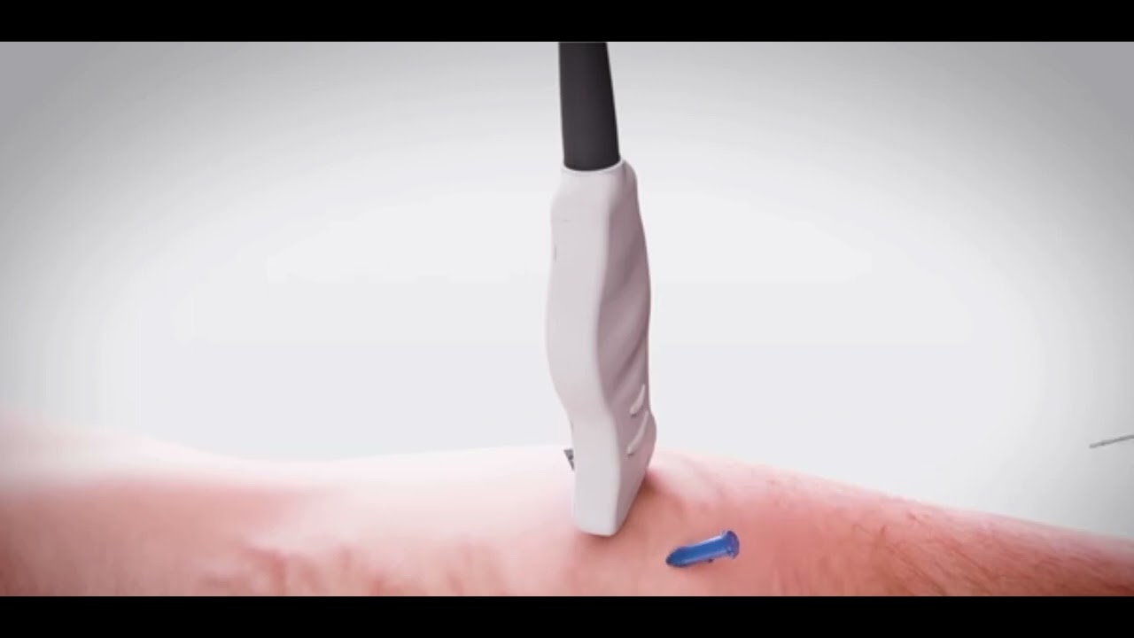 What Is Radiofrequency Ablation Treatment?