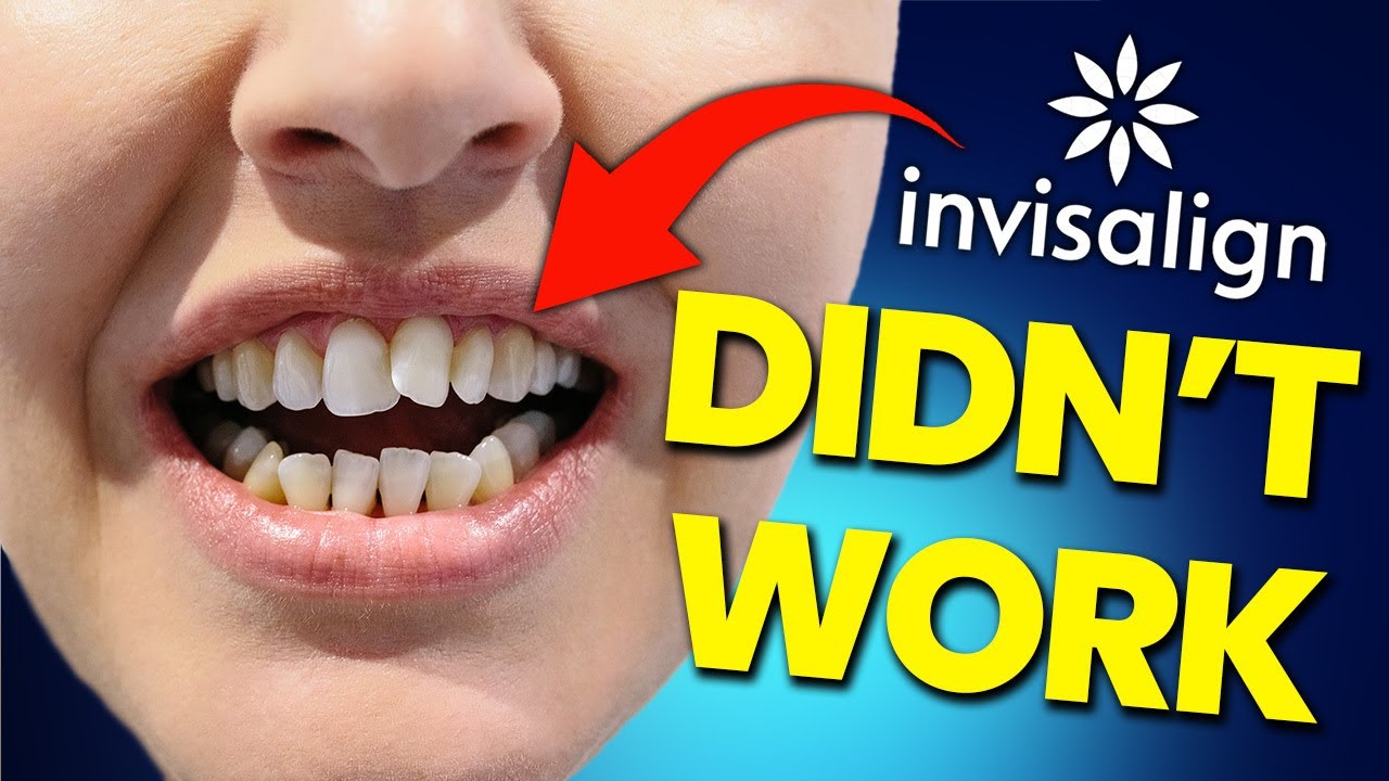 СУРОВАЯ ПРАВДА об Invisalign...посмотрите, прежде чем купить