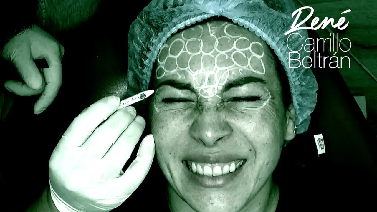 FULL FACE BOTOX