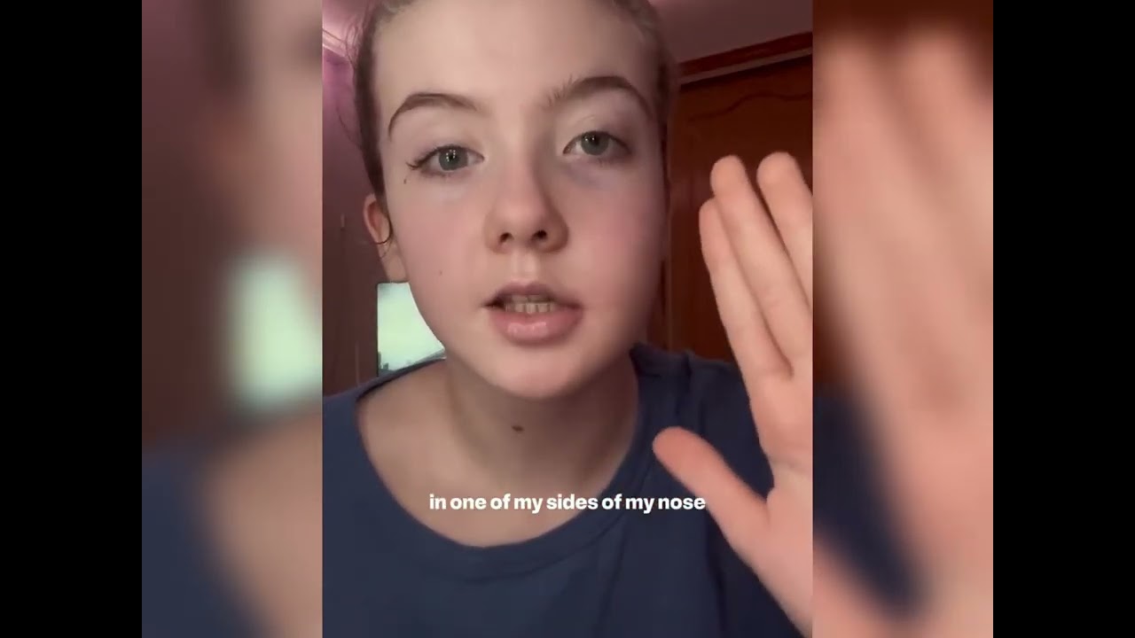 Here is what happened with my face since sooo many of you have been asking_ 💗