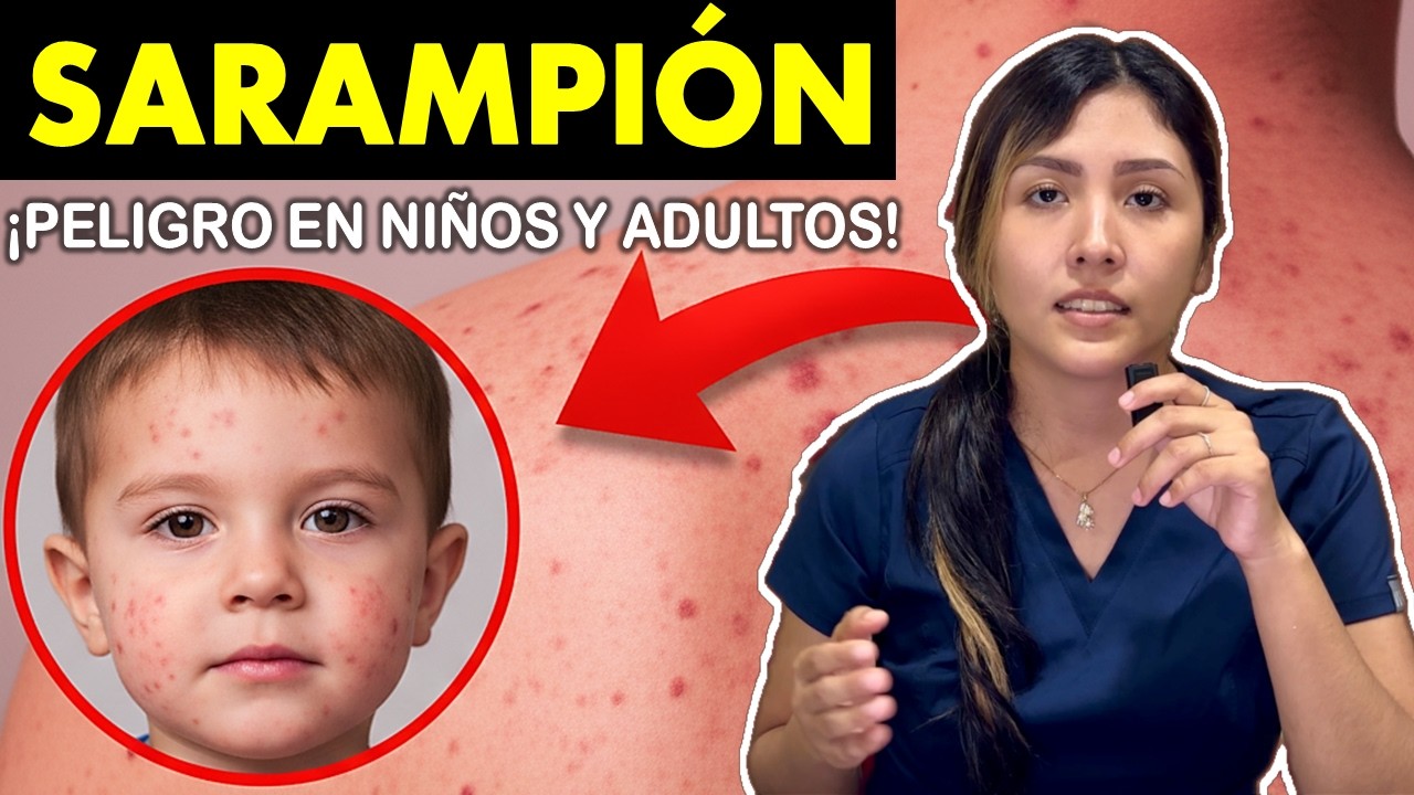 SARAMPIÓN: Síntomas, Diagnóstico y Prevención (Guía 2026) 🩺