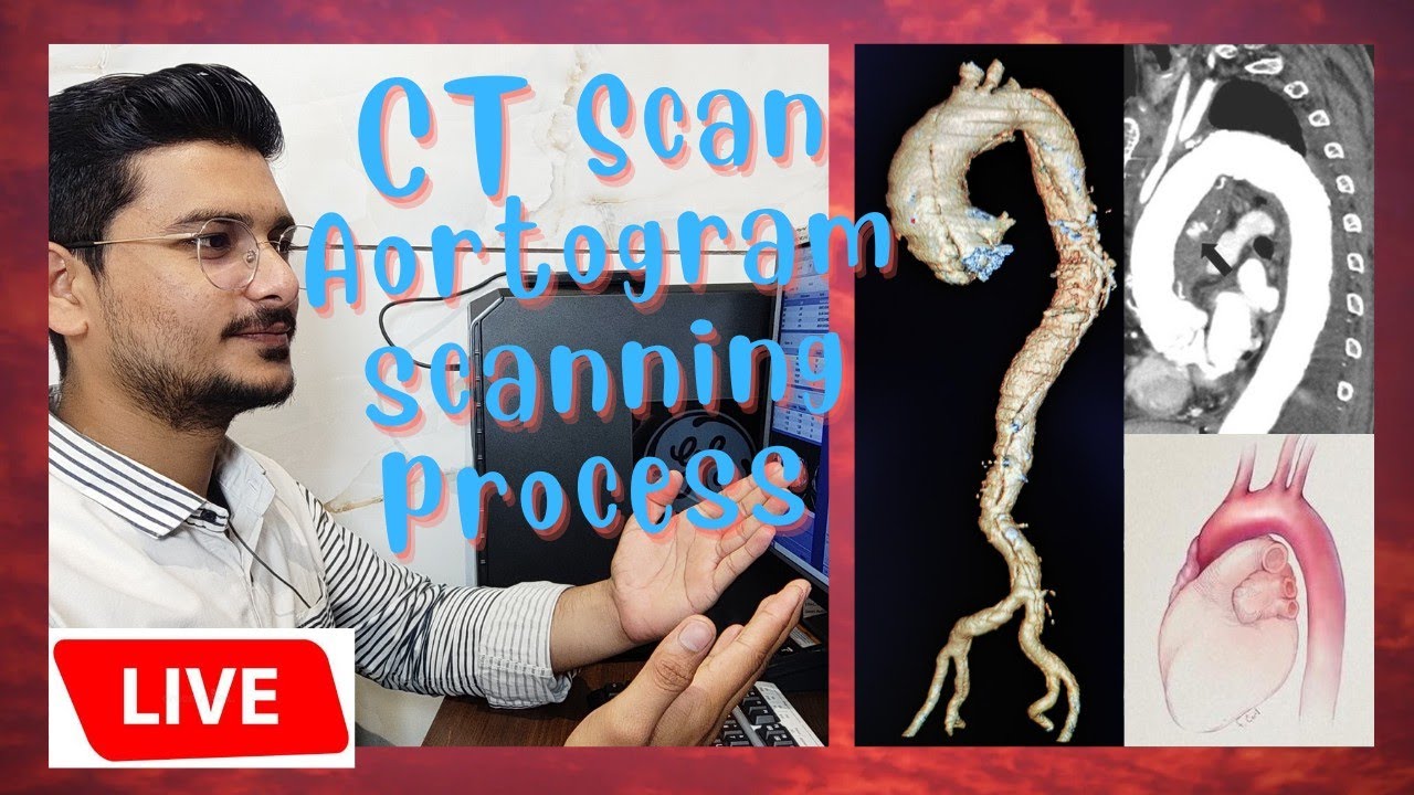live CT Scan Aortogram scanning process and techniques | scanning process of Aortic Angiography.