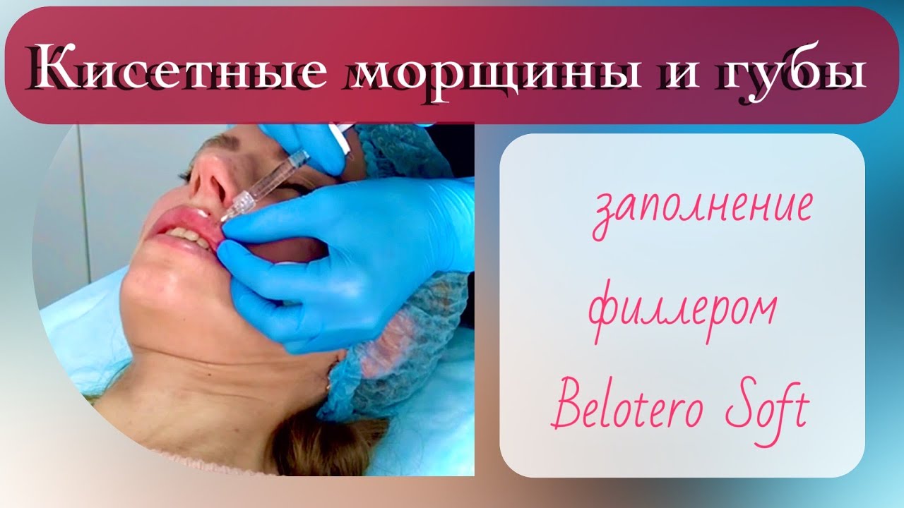 Заполнение кисетных морщин филлером Belotero Soft и увеличение губ