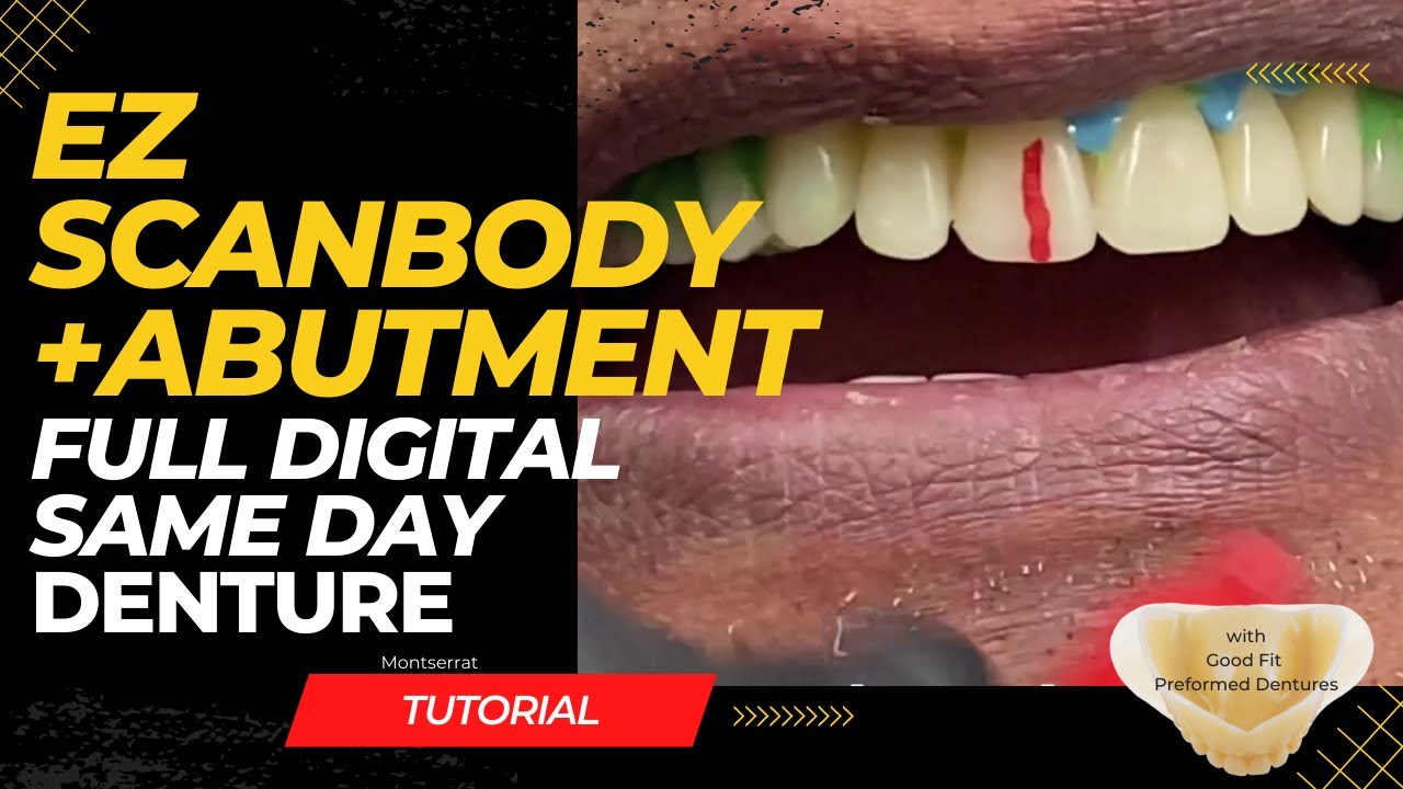 Same Day Digital Denture - (most efficient technique)