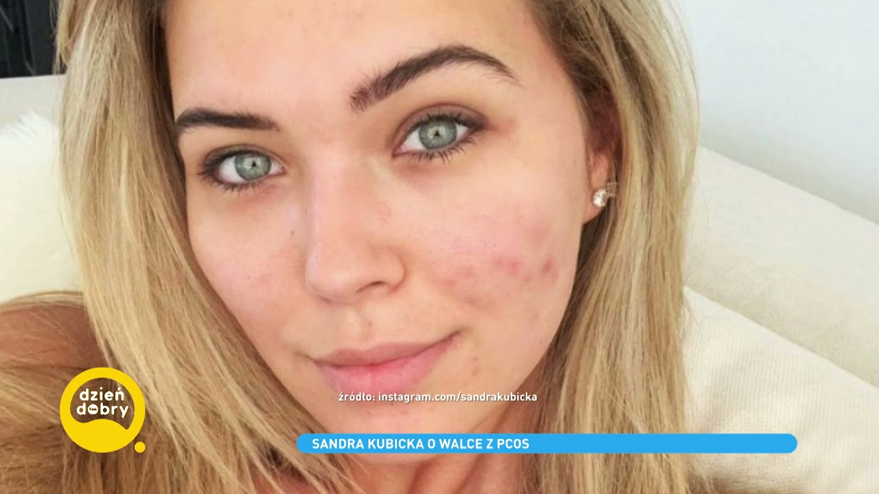 Sandra Kubicka szczerze o walce z PCOS. 