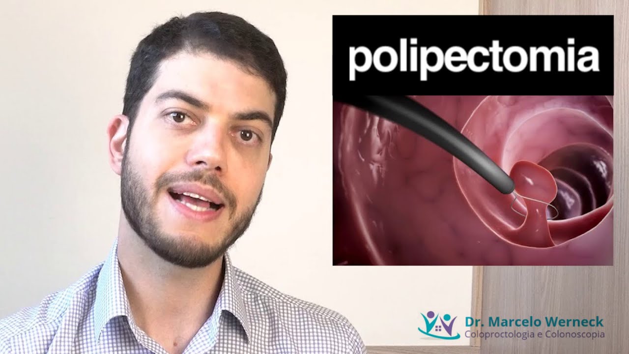 Como é a retirada de pólipos intestinais?