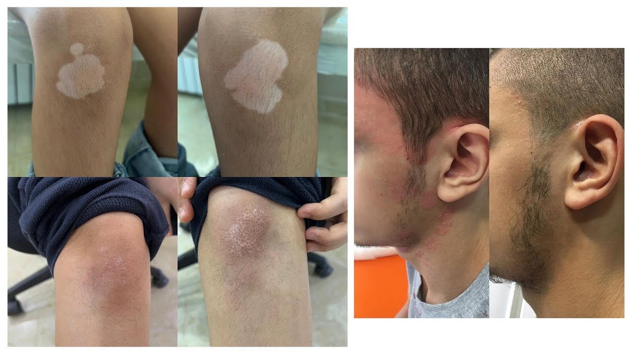 #vitiligotreatment #psoriasis treatment with Kernel 311nm UVB lamp KN-4003BL. #kn4003bl
