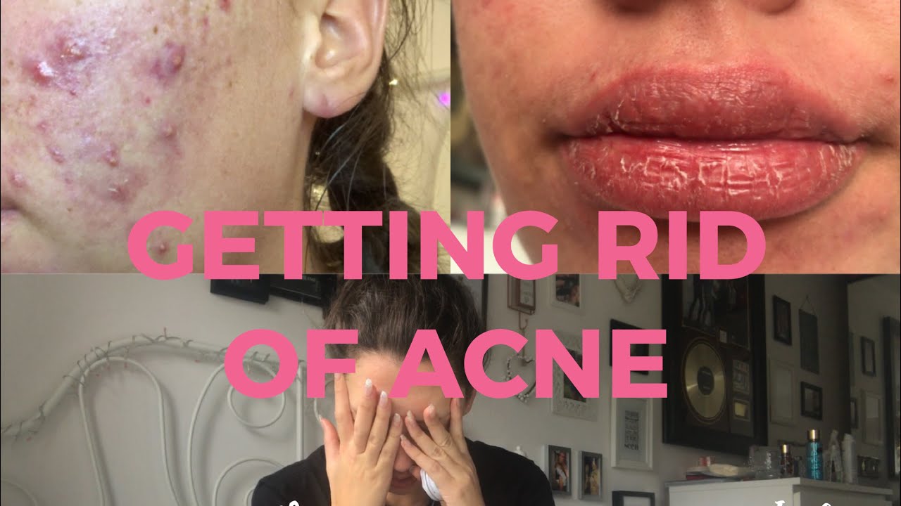 My Roaccutane Experience | MONTH ONE | Sarah Jennings