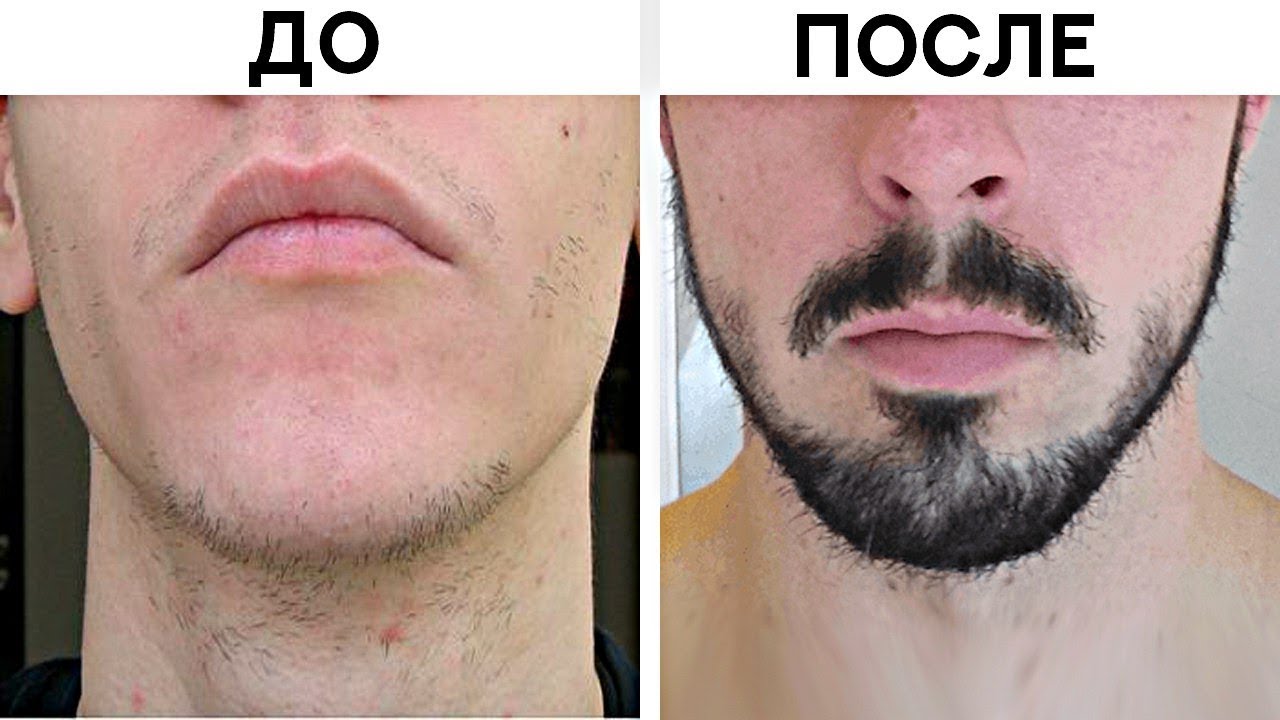 5 Способов Быстро Отрастить Бороду