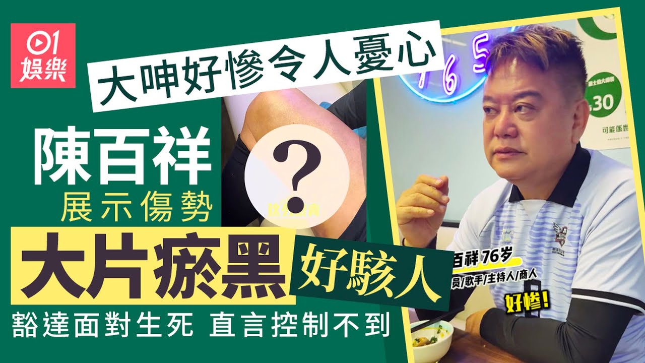 【01秒看娛樂】陳百祥血管爆了展示傷勢大片瘀黑好駭人　看淡生死不排斥安樂死｜01娛樂｜陳百祥｜香港明星｜香港藝人