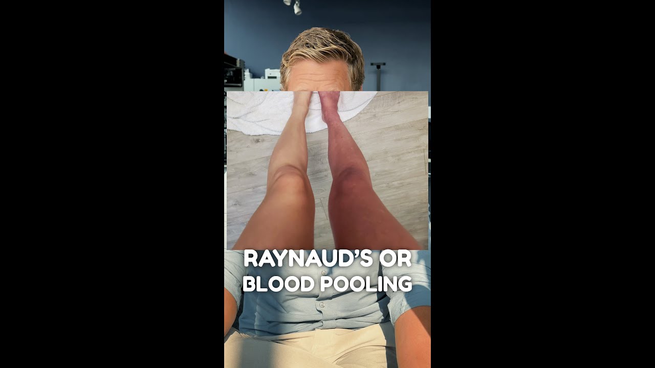 Difference Between Raynaud's Syndrome and Blood Pooling? #pots #dysautonomia #concussion #headinjury