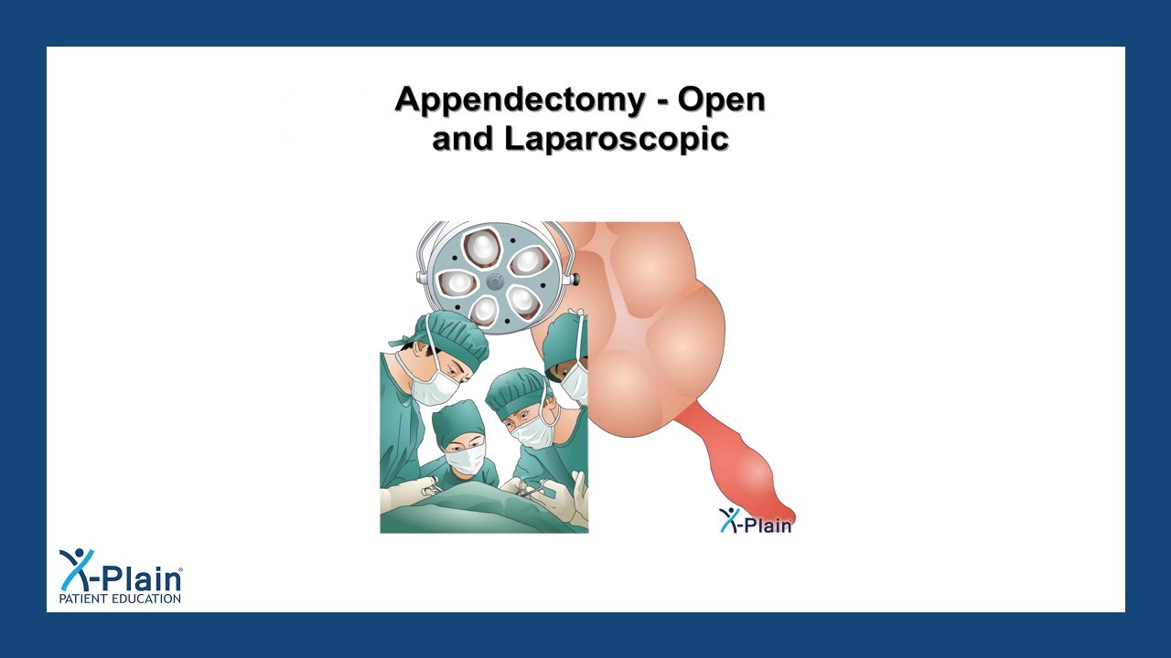 Appendectomy - Open and Laparoscopic