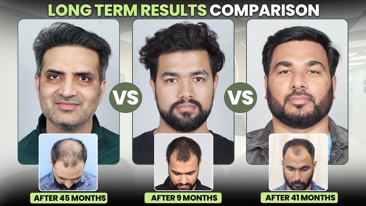 Best Hair Transplant in Gurgaon (HX-HGFD) | Best Results & Cost of Hair Transplant in Gurgaon.