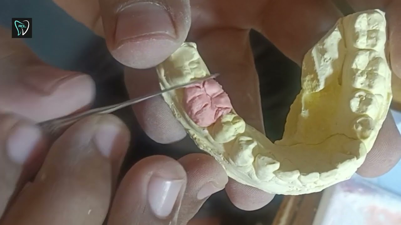 A single Molar build up Porcelain Crown