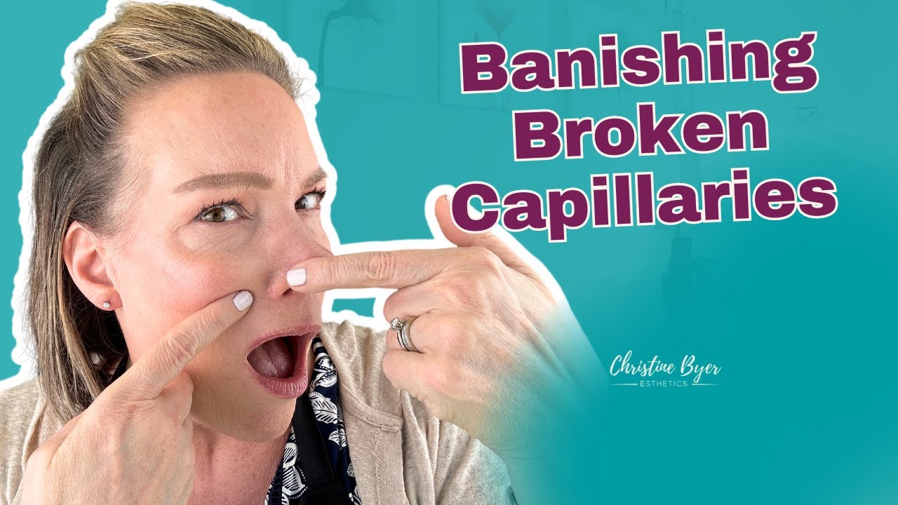 How to Get Rid of Broken Capillaries on the Face