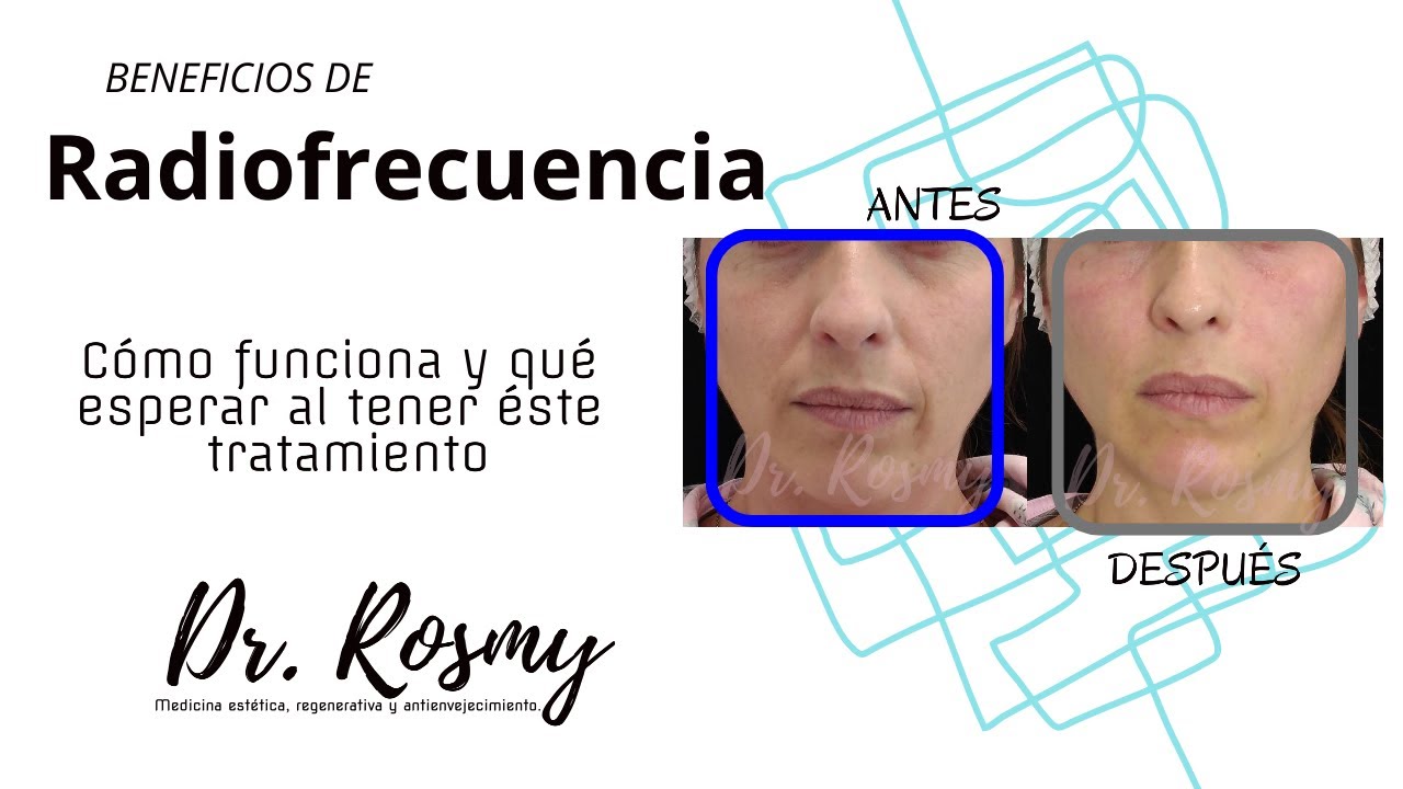 Beneficios de la RADIOFRECUENCIA - ¿Cómo funciona, qué esperar durante y después del tratamiento?