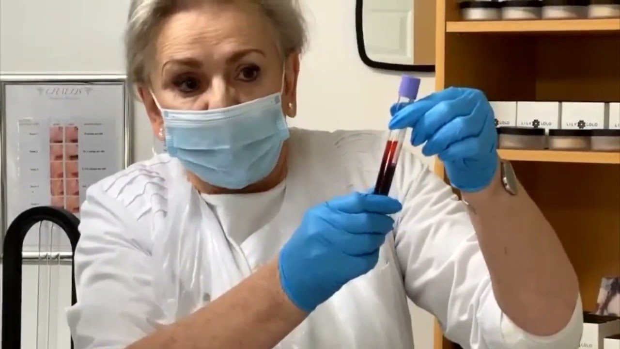 iPRF injectable Platelet Rich Fibrin   The Next Generation PRP Vampire Facial