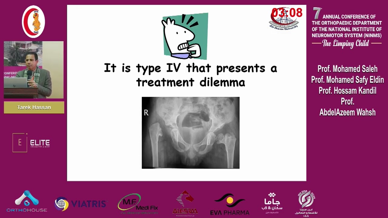 Managment sequelae of post septic hip- Tarek Hassan
