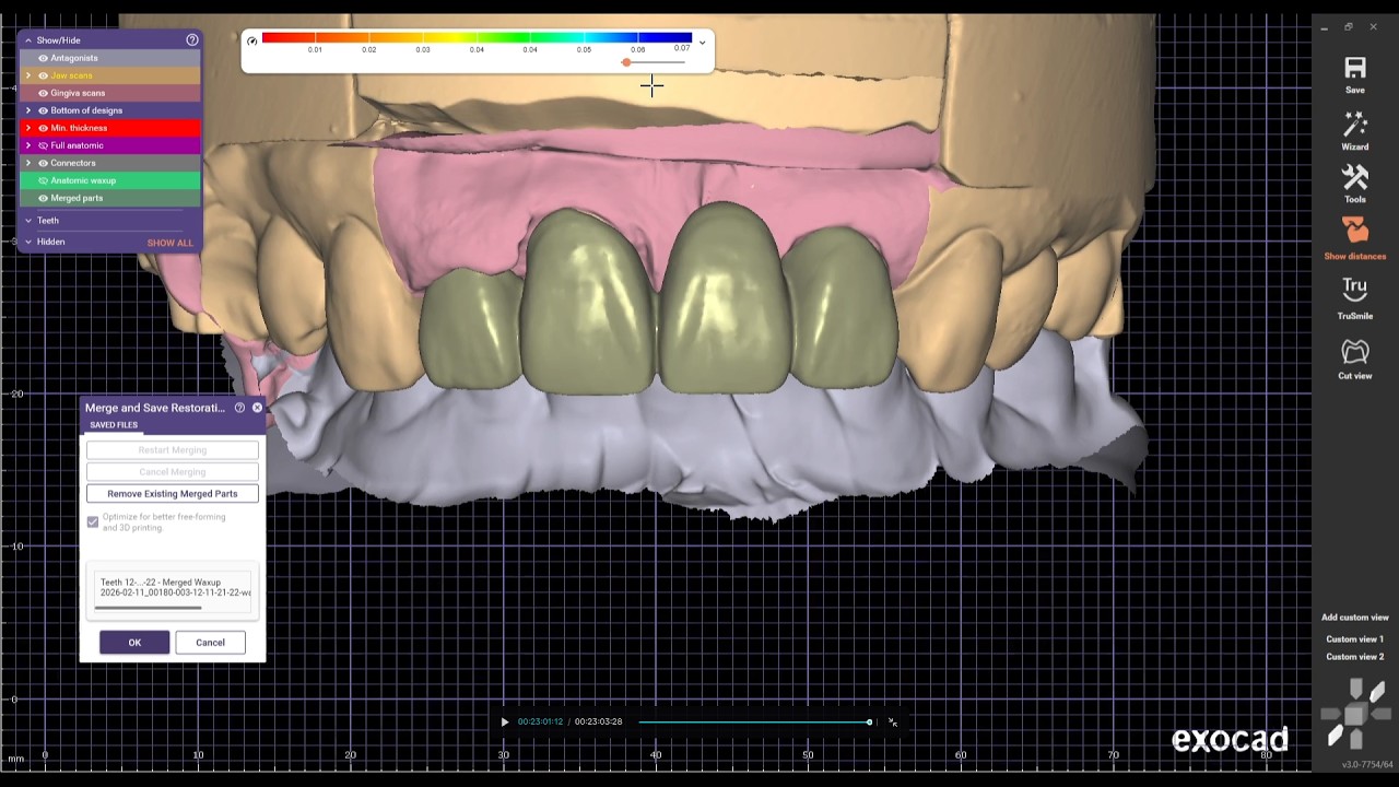 Anterior teeth bridge design