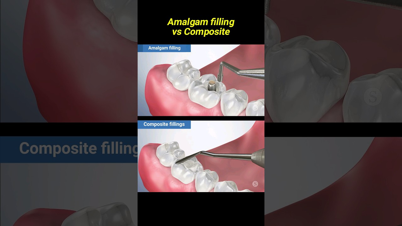 Amalgam filling vs composite #dentist #dentisty #filling