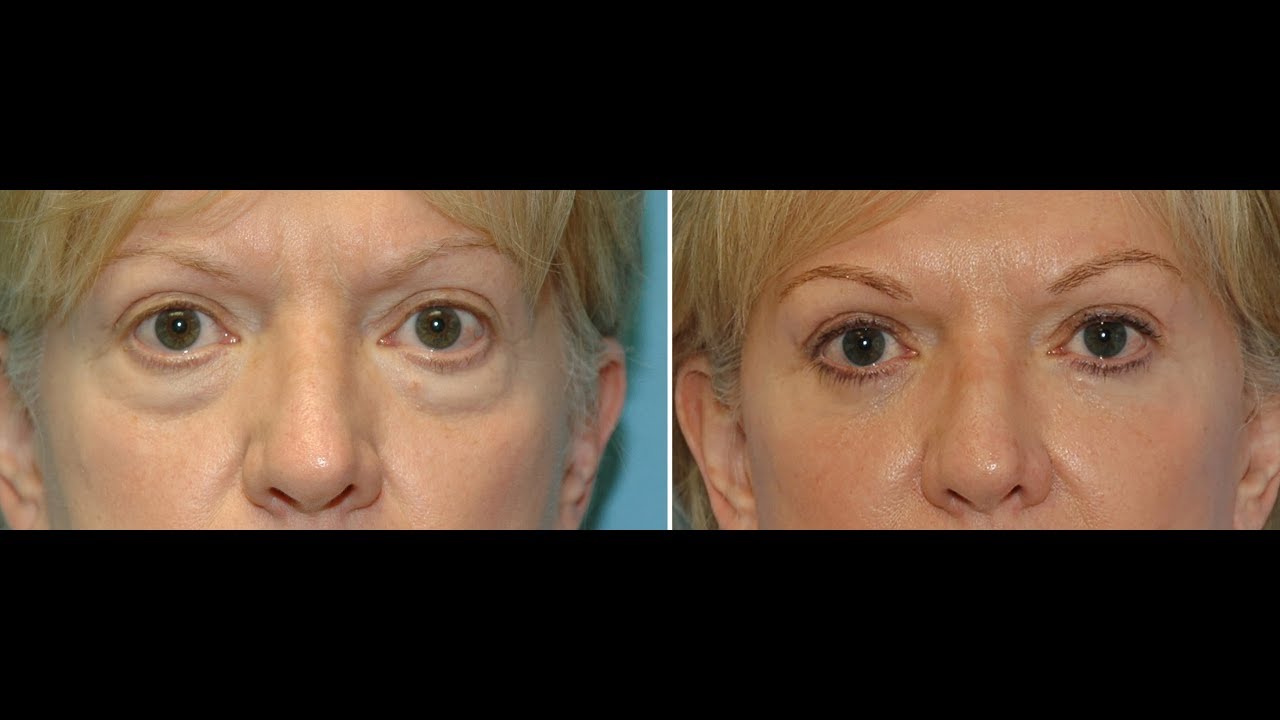 Lower Eyelid Rejuvenation with Blepharoplasty by Dr. Timothy R. Miller, M.D.
