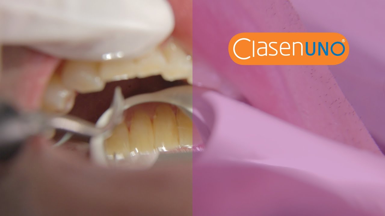 ClasenUNO - Prophylaxe (english)